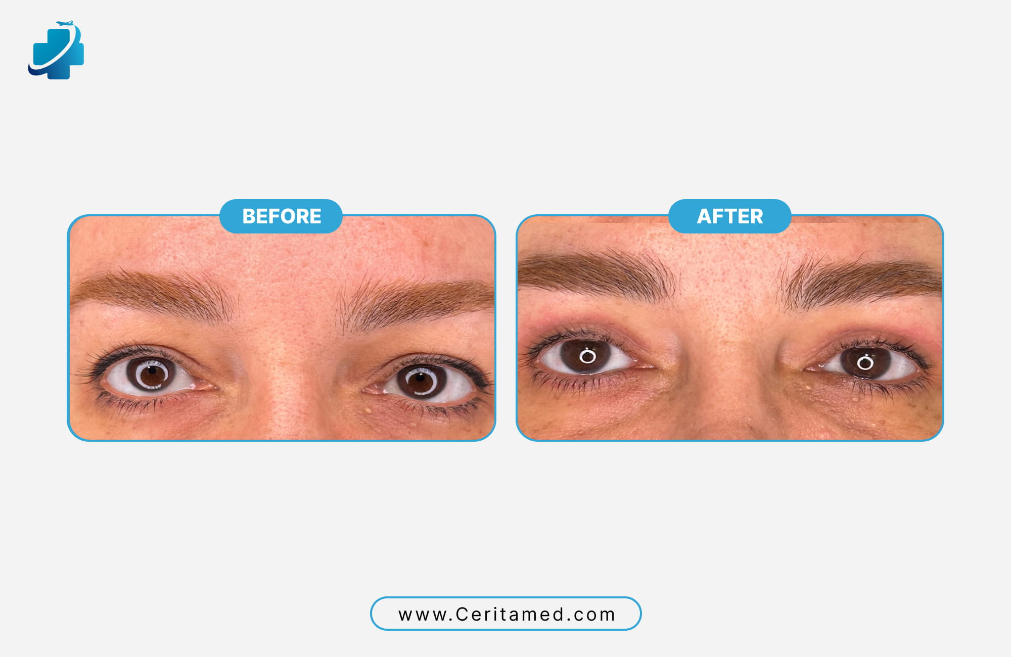 Successful eyebrow transplant over an old tattoo showing realistic hair texture and density by Ceritamed.