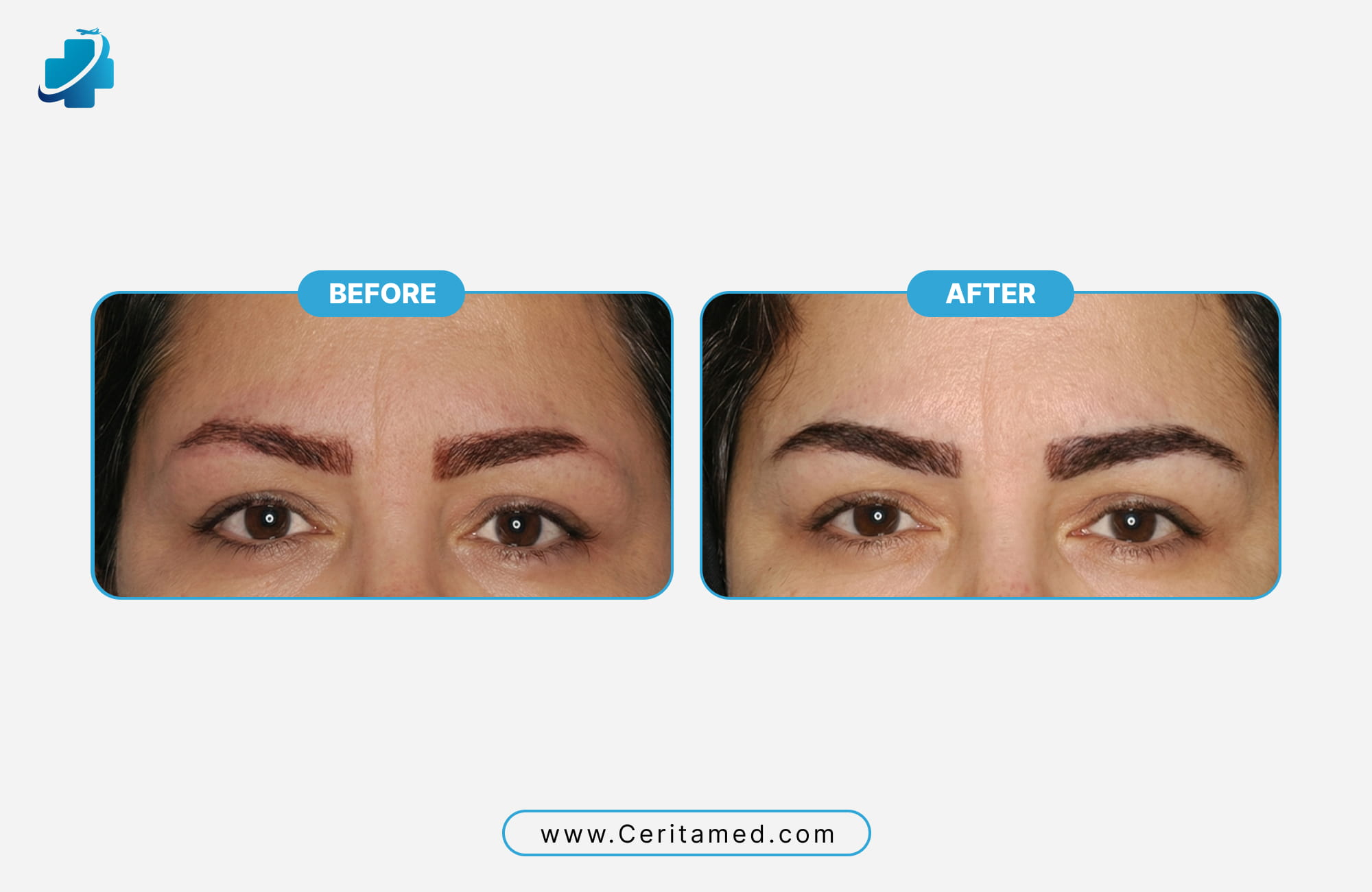 Side-by-side comparison of eyebrow transplant before and after results showing natural hair density and shape by Ceritamed.
