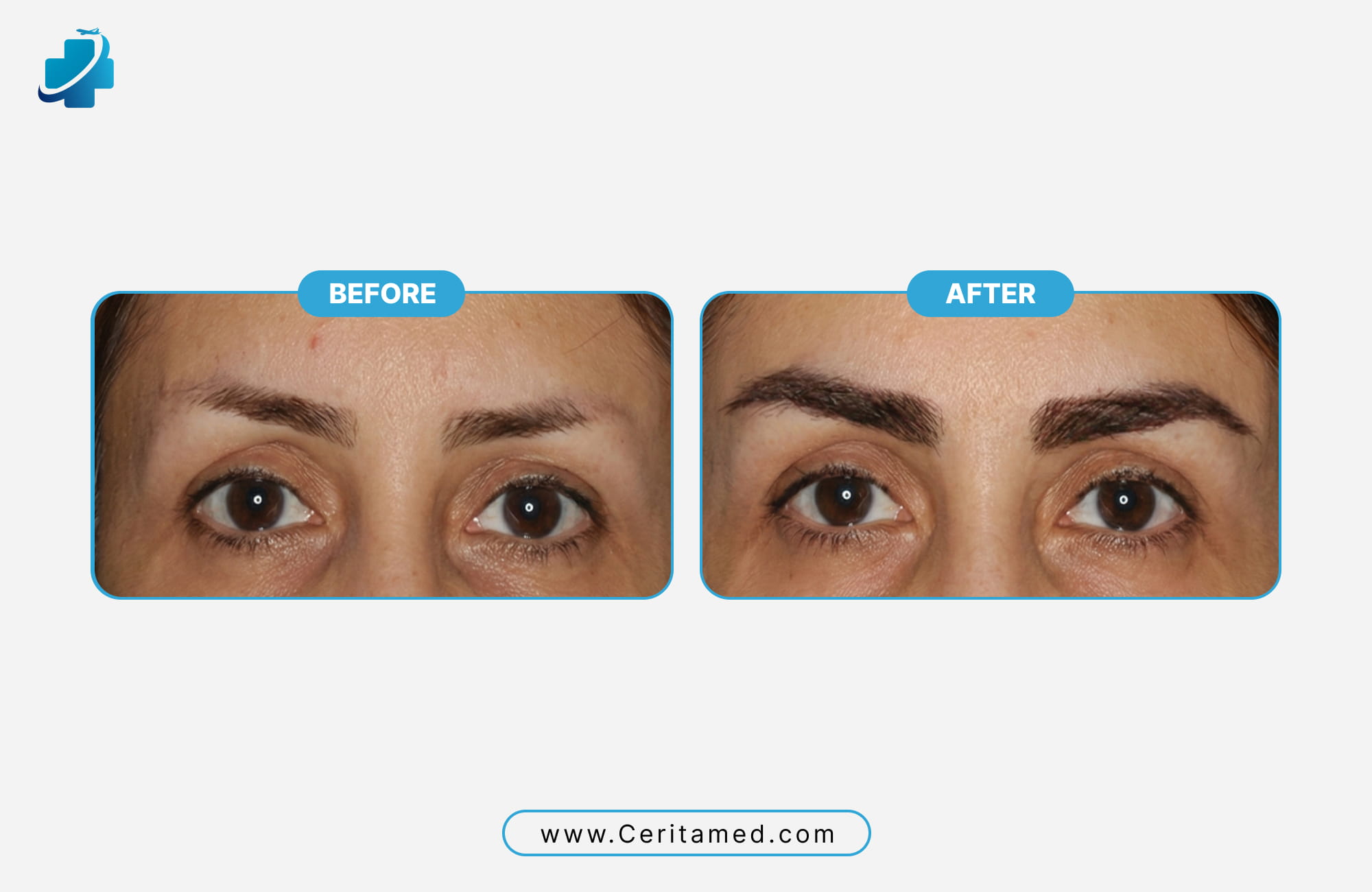 Patient results showing natural-looking eyebrow restoration and improved symmetry by Ceritamed.