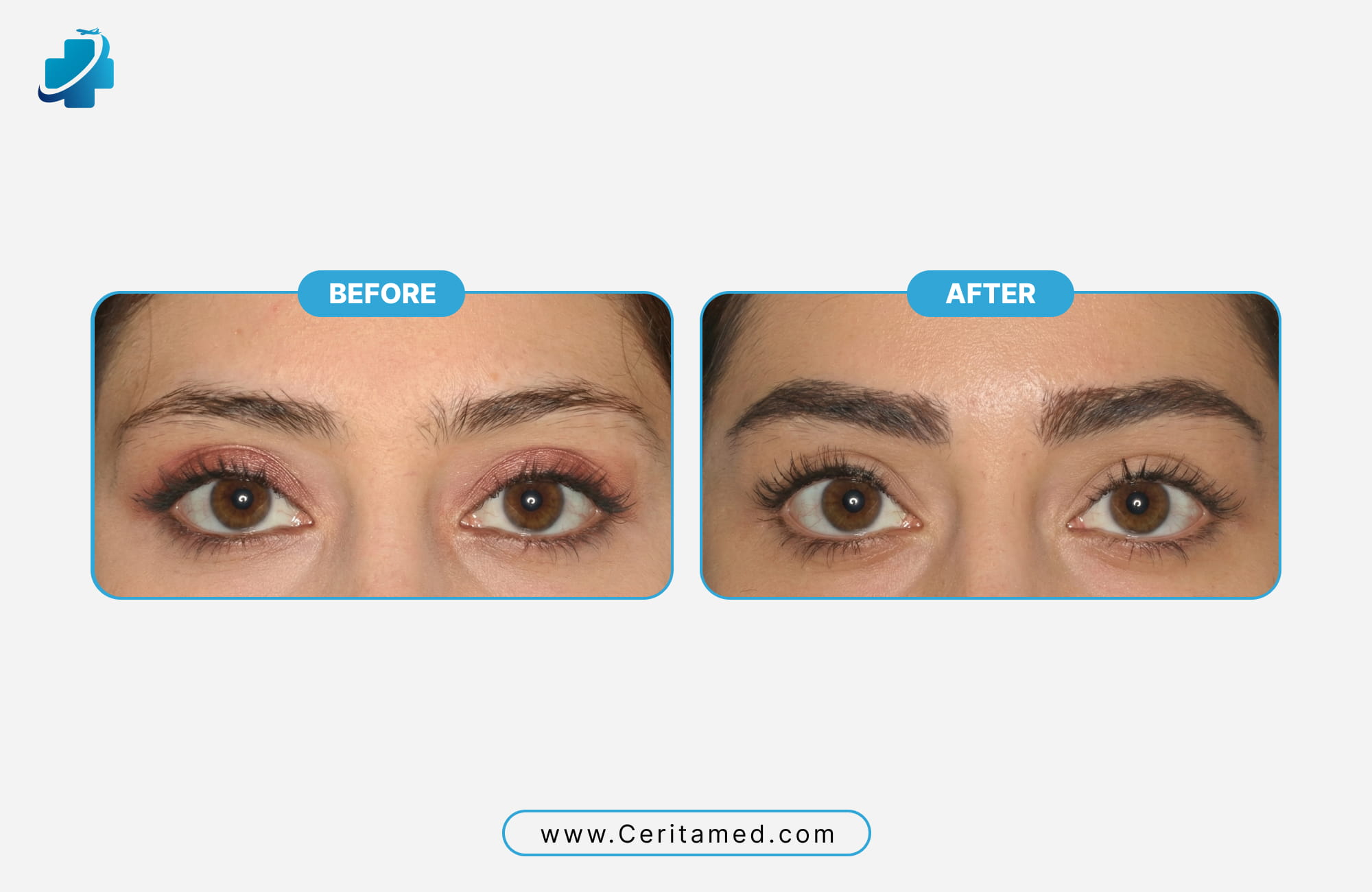 Side-by-side comparison of soft and natural feminine eyebrow transplant results by Ceritamed in Iran.