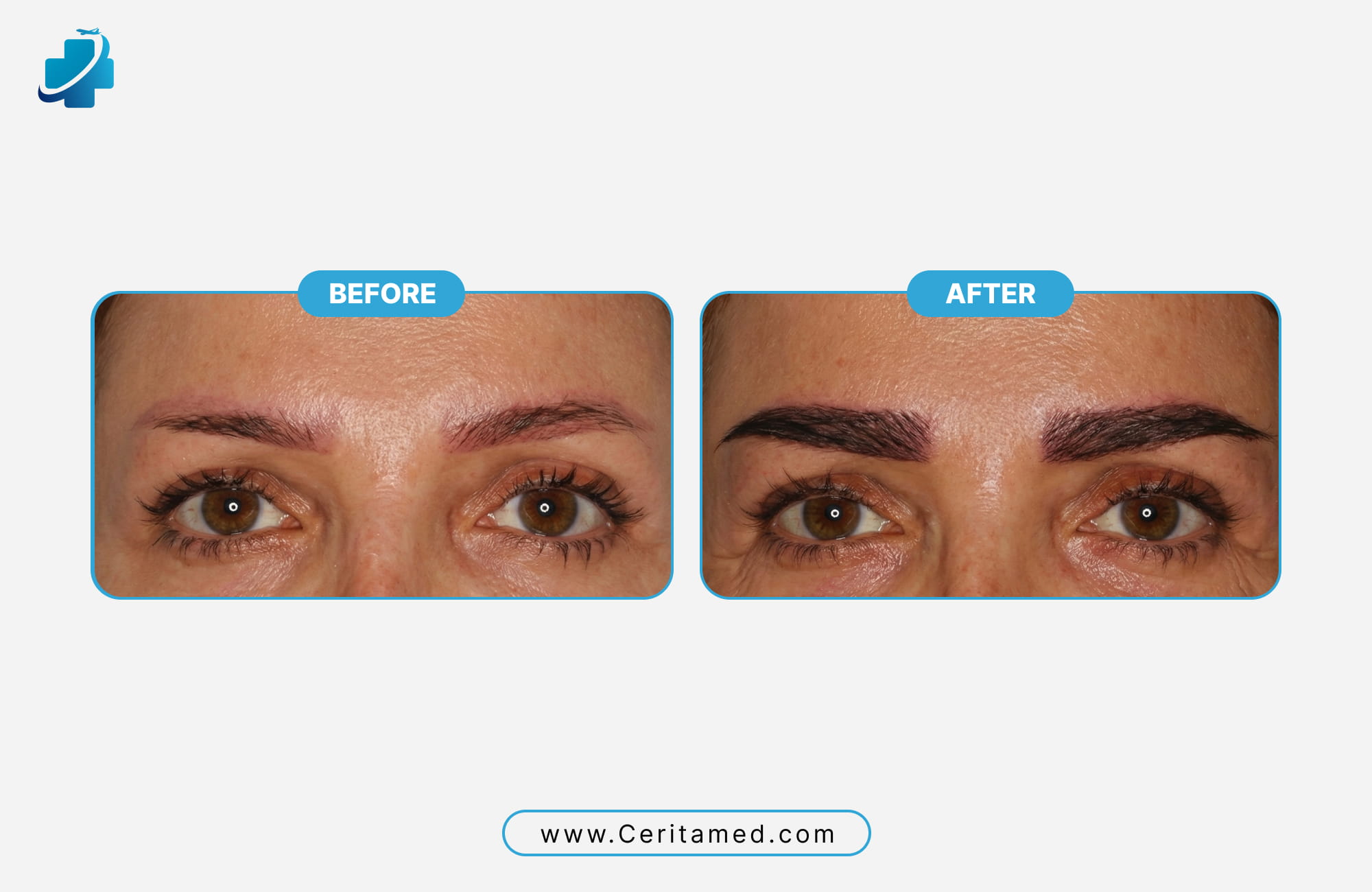 Successful eyebrow transplant over an old tattoo showing realistic hair texture and density by Ceritamed.