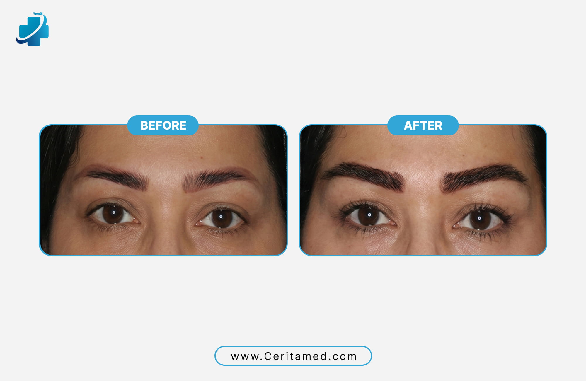 High-density eyebrow transplant results showing bold and realistic hair texture by Ceritamed.
