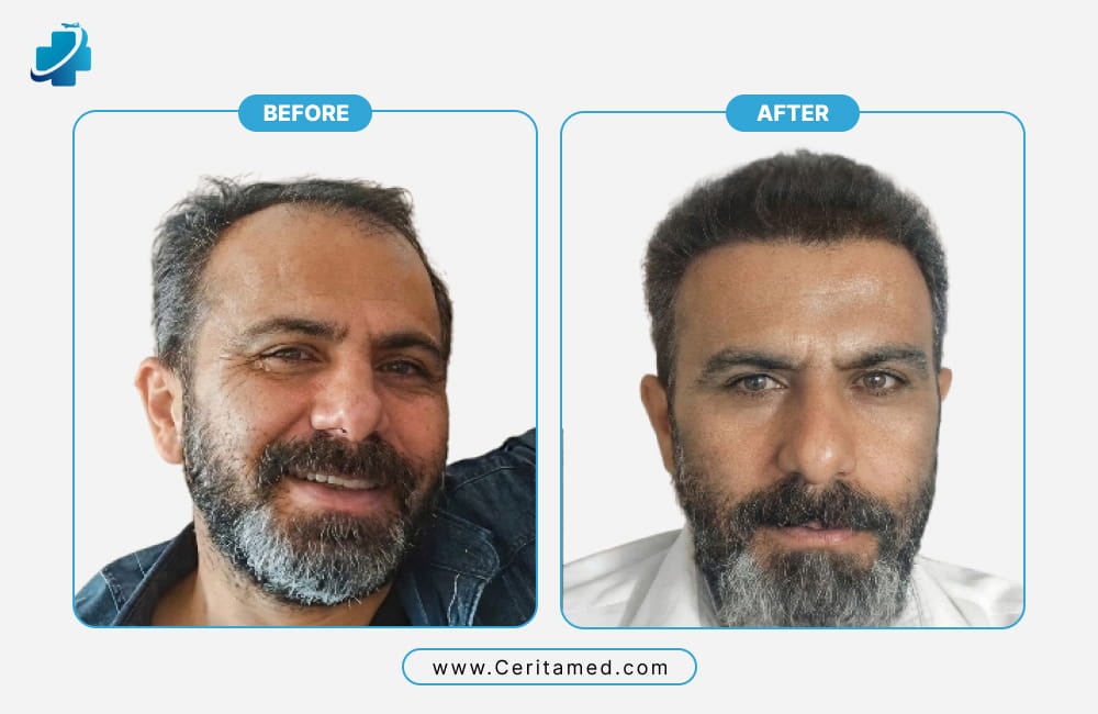Hair transplant before and after showing frontal hairline density restoration in Iran at Ceritamed