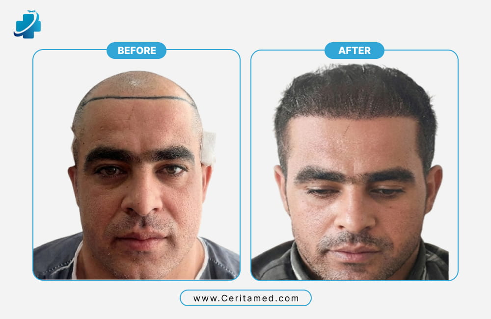Hair transplant before and after showing natural hairline reconstruction and density restoration in Iran at Ceritamed
