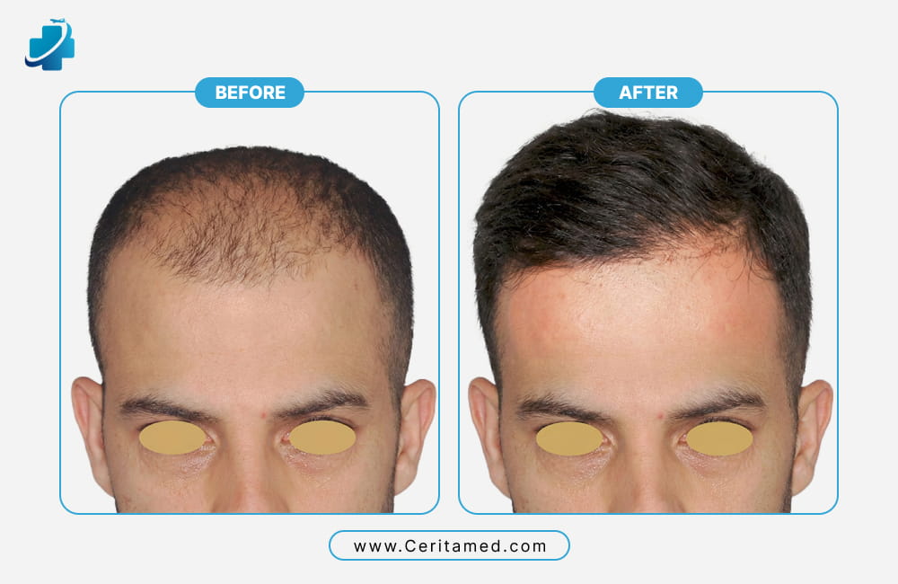 Hair transplant before and after results showing frontal hairline reconstruction and natural density improvement at Ceritamed
