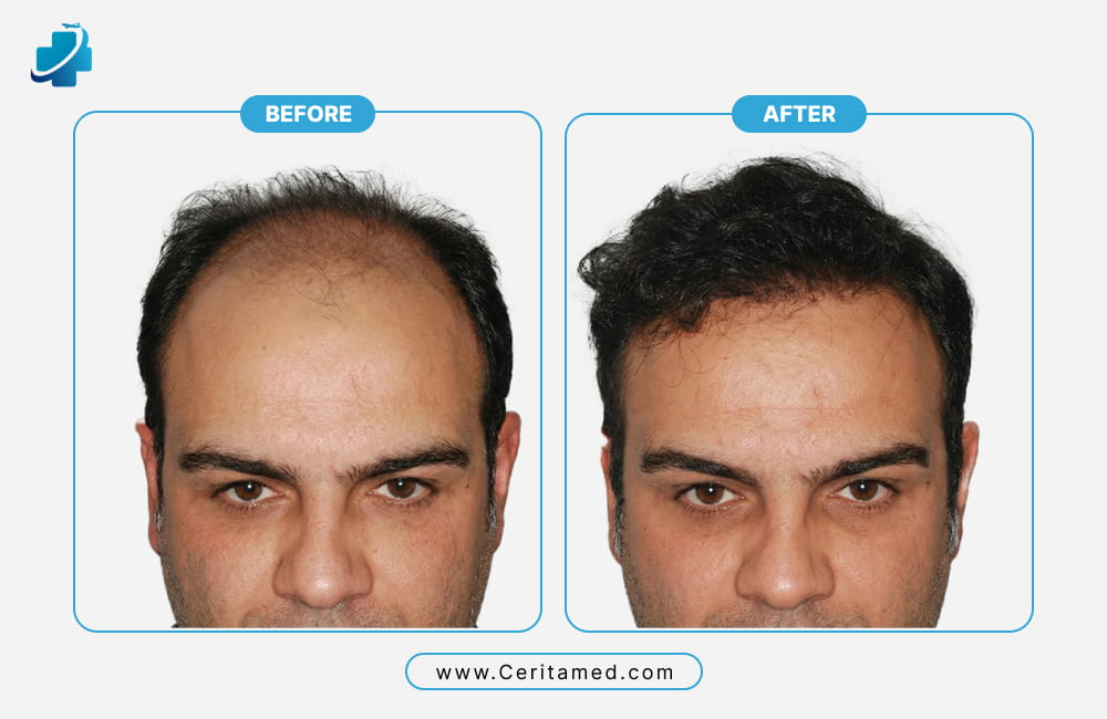 Hair transplant before and after results showing natural frontal hairline restoration and density improvement at Ceritamed