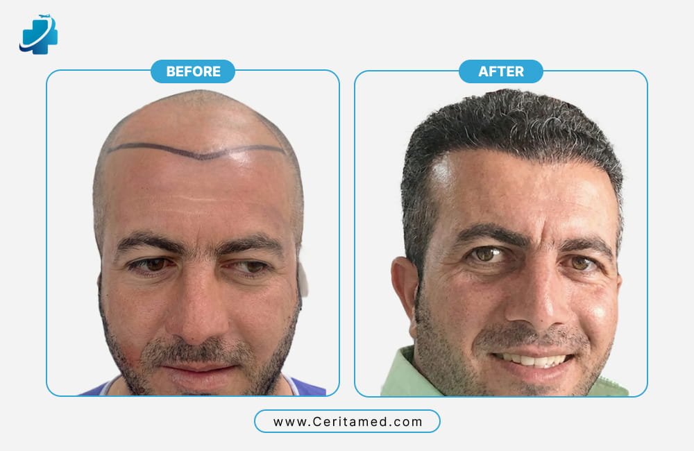 Hair transplant before and after results showing professional hairline design and natural density restoration at Ceritamed