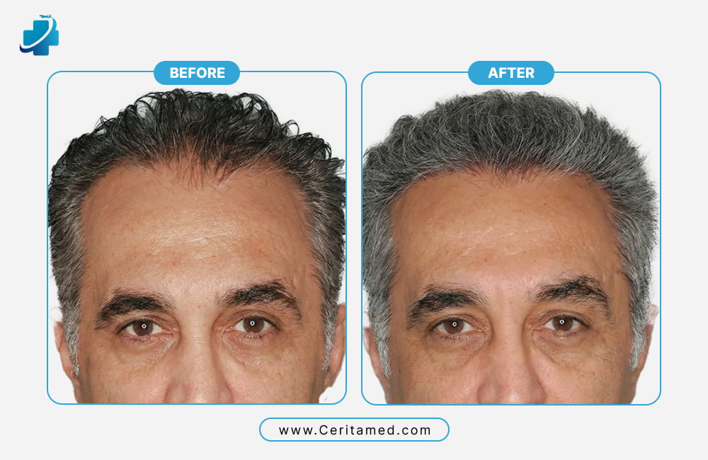 Hair transplant before and after results showing mature hairline restoration and natural density improvement at Ceritamed