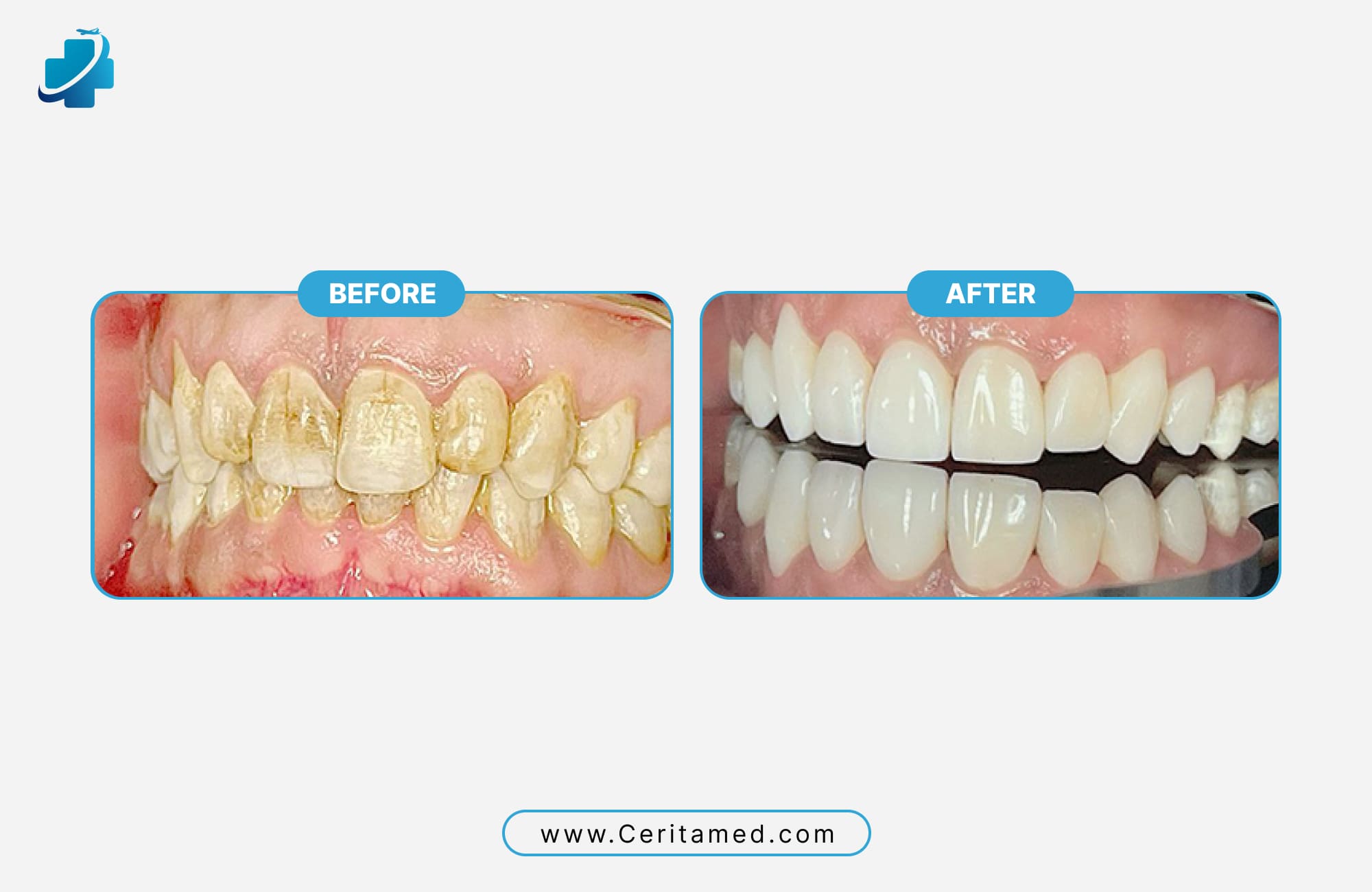 Hollywood Smile before and after veneer transformation showing stained teeth corrected with cosmetic dentistry at Ceritamed