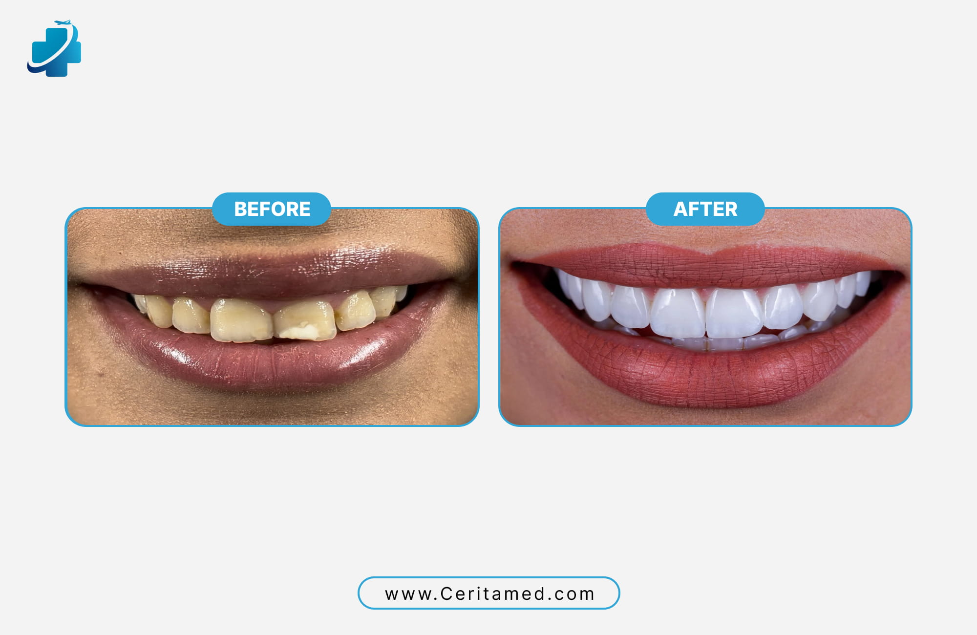 Professional Hollywood smile in Iran results showing the transformation of discolored teeth into a bright, white smile.