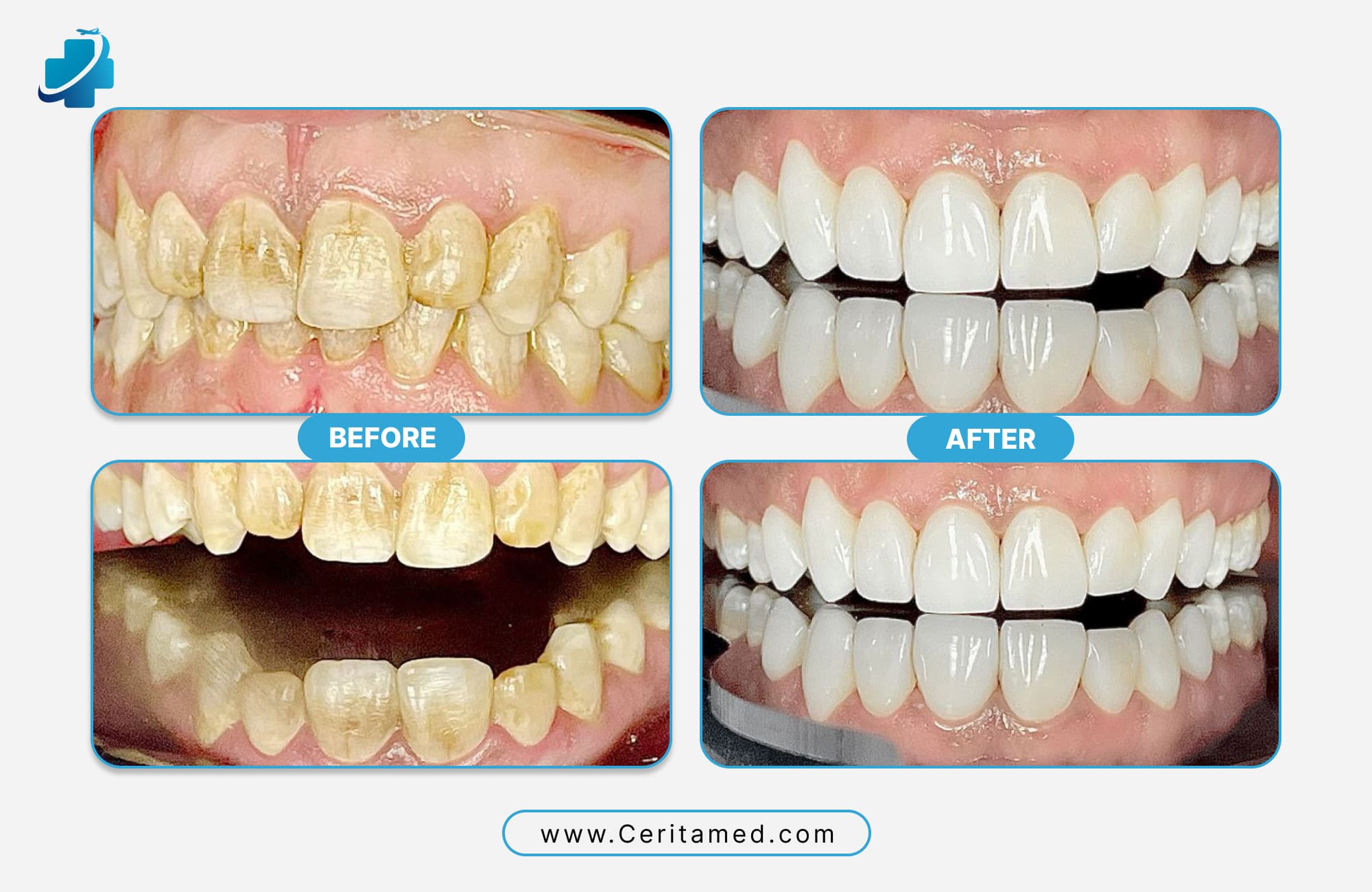 Hollywood Smile before and after full mouth veneer transformation at Ceritamed cosmetic dentistry clinic