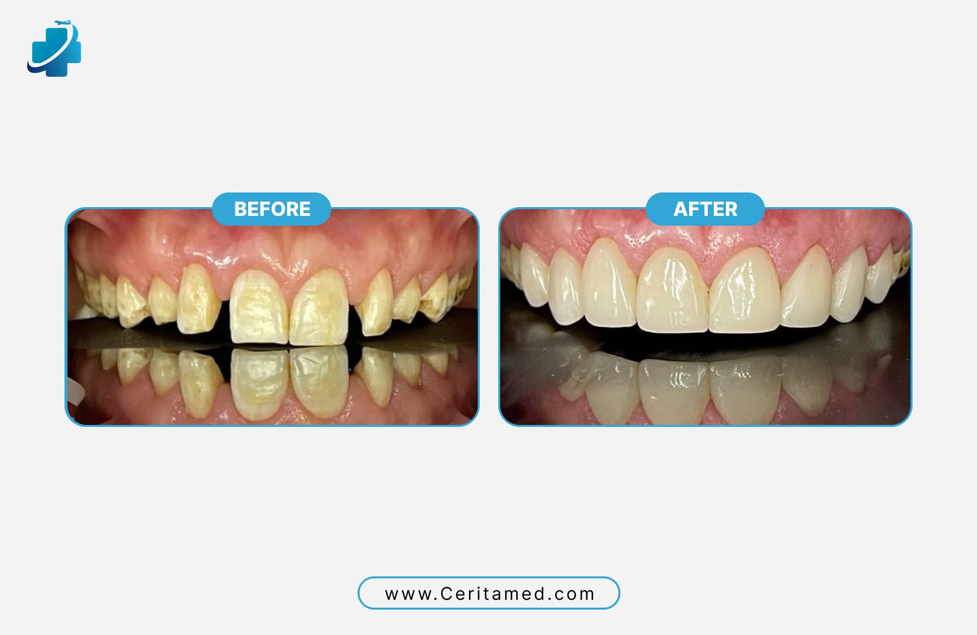 Hollywood Smile before and after transformation correcting severe tooth discoloration with veneers at Ceritamed
