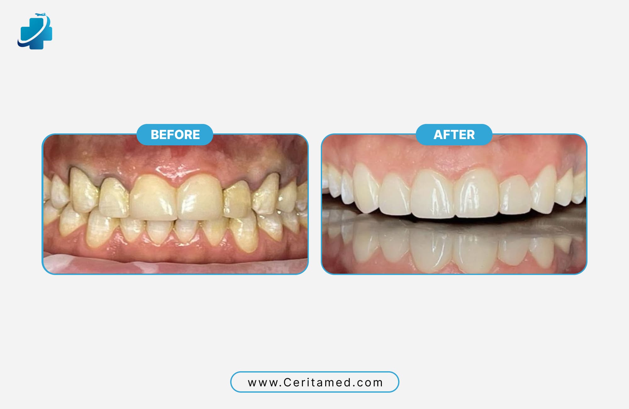Hollywood Smile before and after correcting crowded and stained teeth with veneer smile makeover at Ceritamed