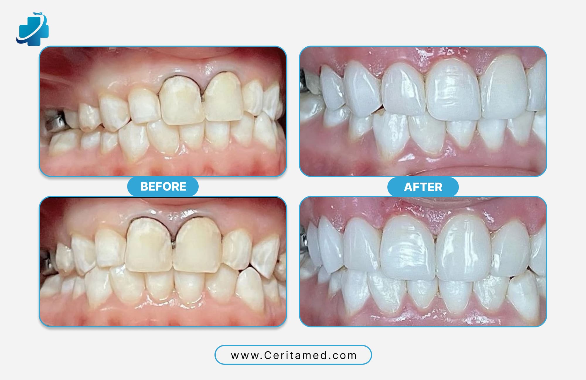 Hollywood Smile before and after correcting misaligned and uneven colored teeth with custom veneers at Ceritamed