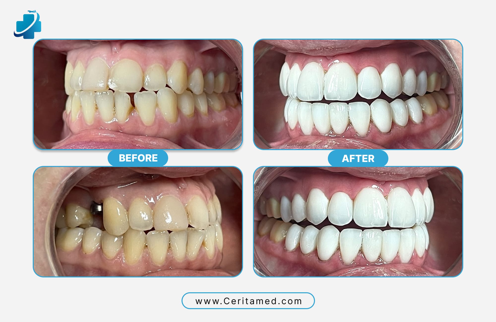 Hollywood Smile before and after correcting severe crowding and bite alignment with full veneer smile makeover at Ceritamed