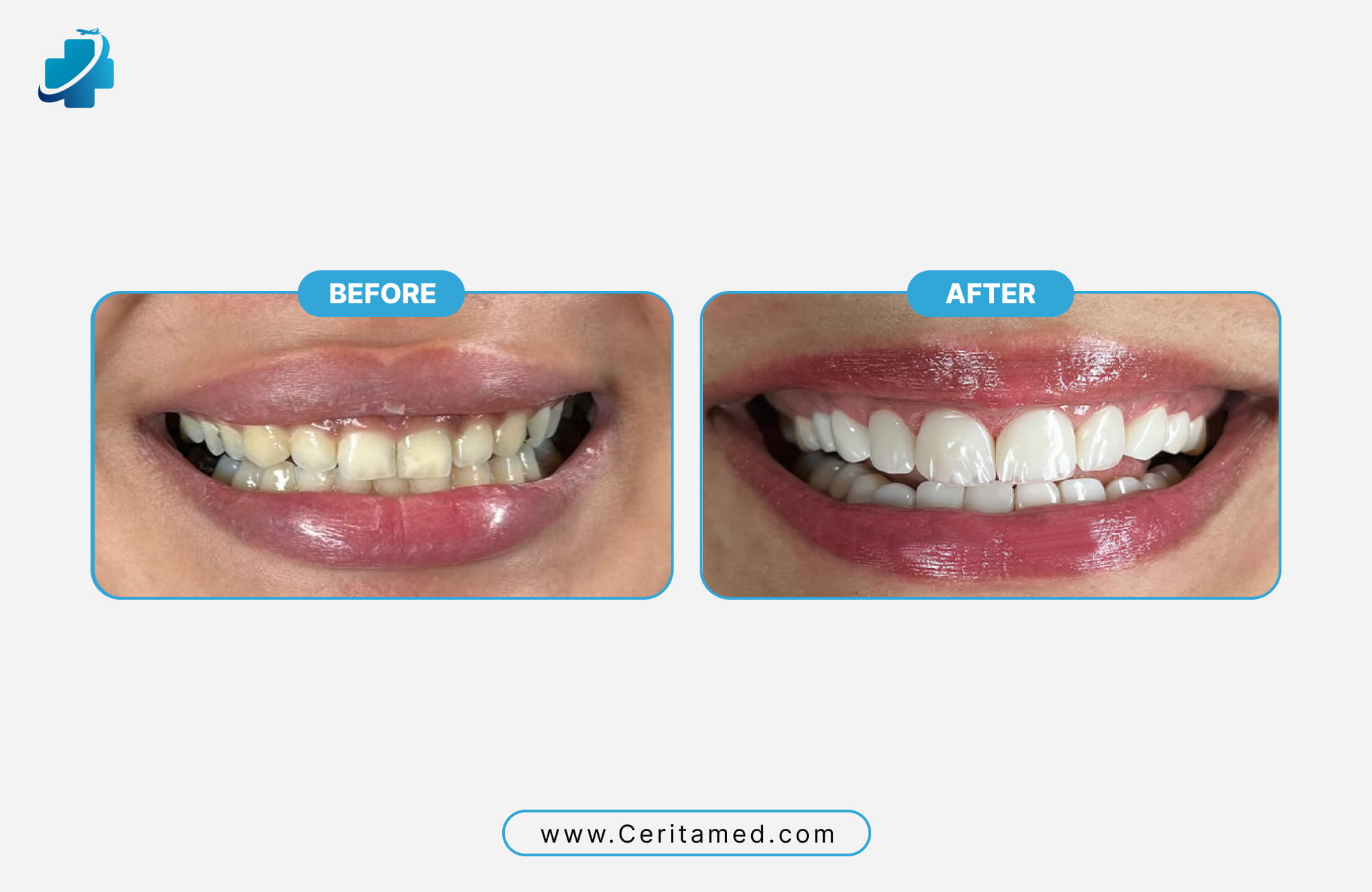 Hollywood smile in Iran before and after results showing teeth whitening and porcelain veneers by Ceritamed.
