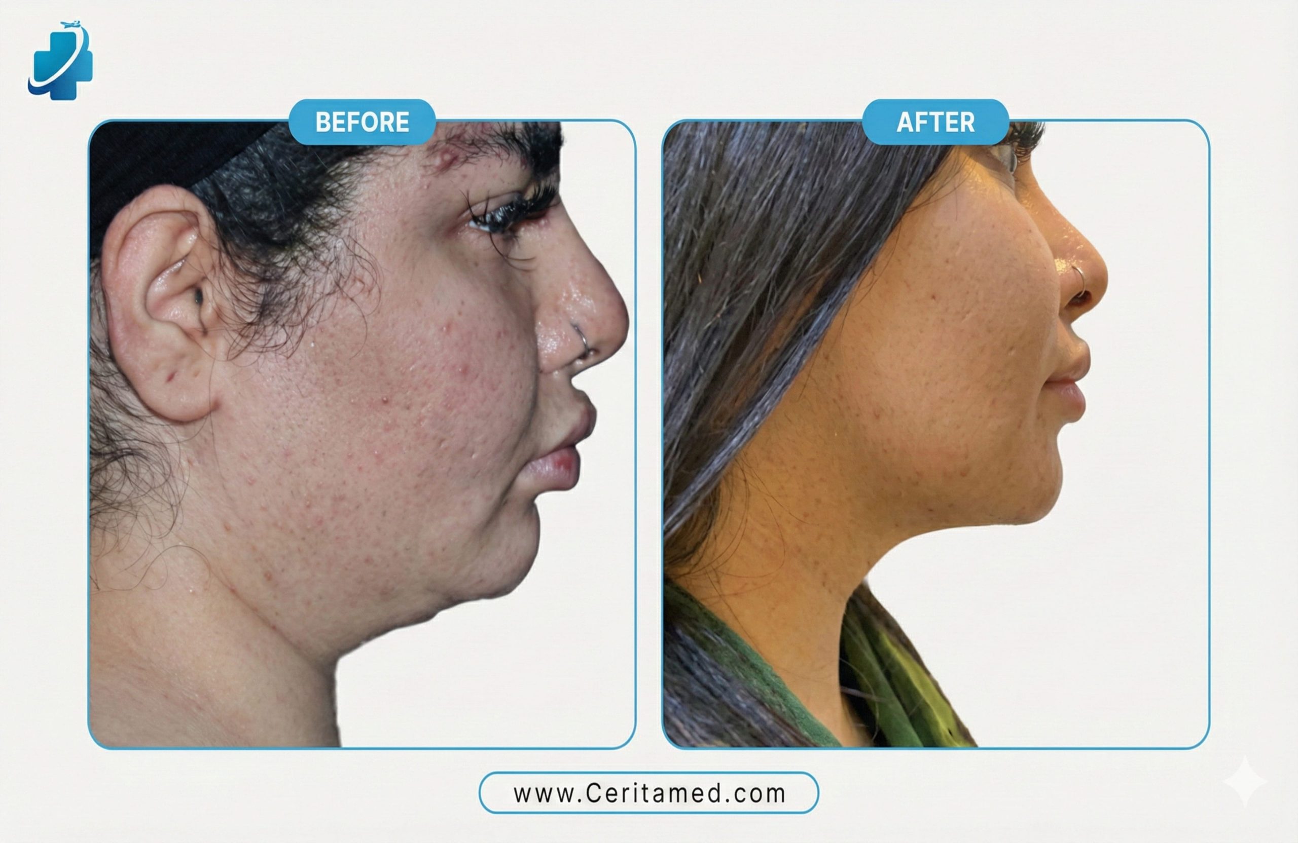 Neck lift before and after in Iran showing double chin reduction and jawline contour improvement at Ceritamed