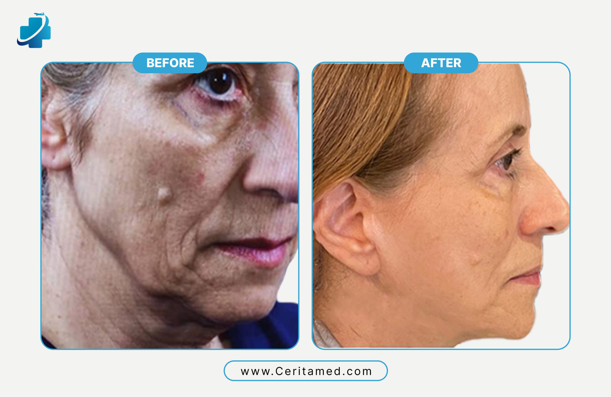 Neck lift before and after in Iran showing neck skin tightening and jawline rejuvenation at Ceritamed