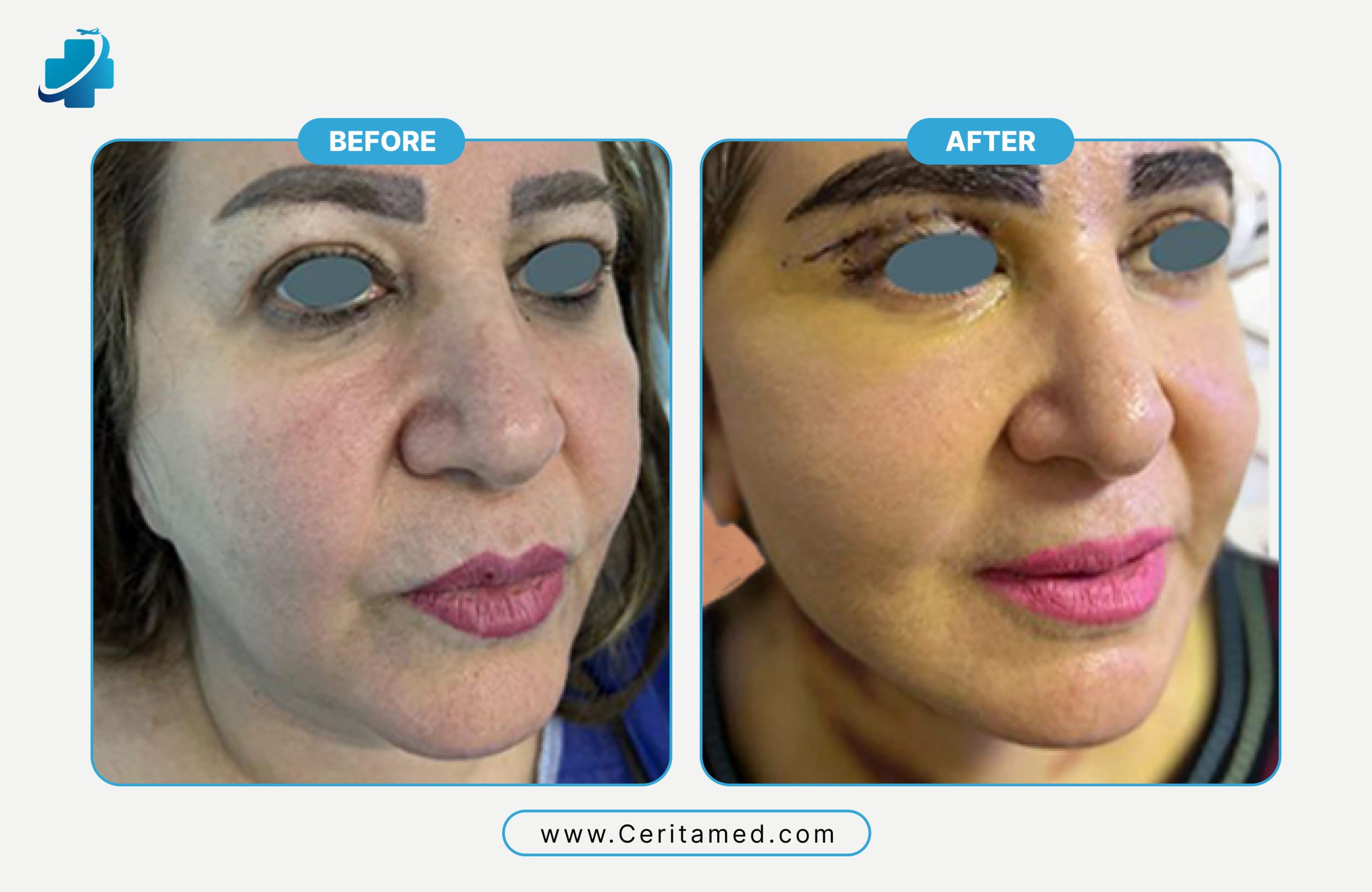 Neck lift before and after in Iran showing smoother neck skin and improved jawline contour at Ceritamed
