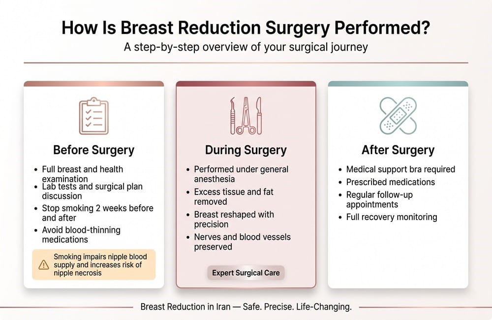 Infographic showing the step-by-step process of breast reduction surgery in Iran including before surgery, during surgery, and recovery stages.