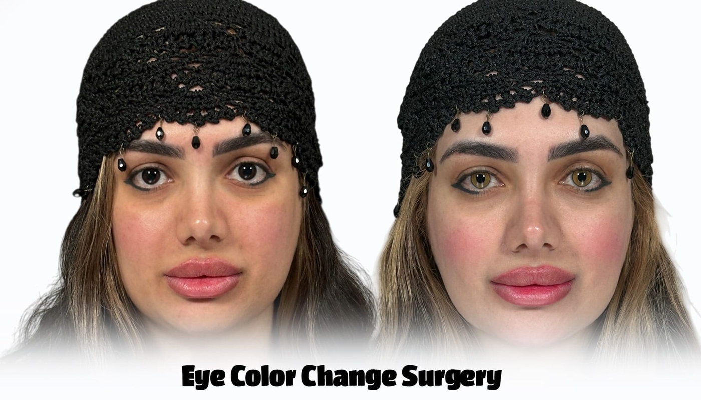 Comparison header image showing a patient's eyes before and after permanent eye color change surgery with Ceritamed.