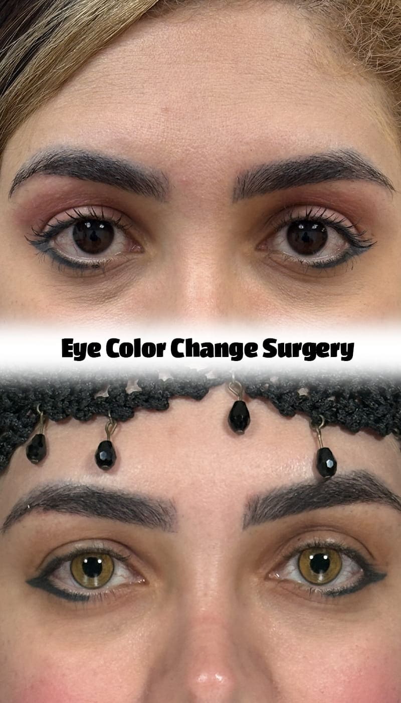 Comparison header image showing a patient's eyes before and after permanent eye color change surgery with Ceritamed.