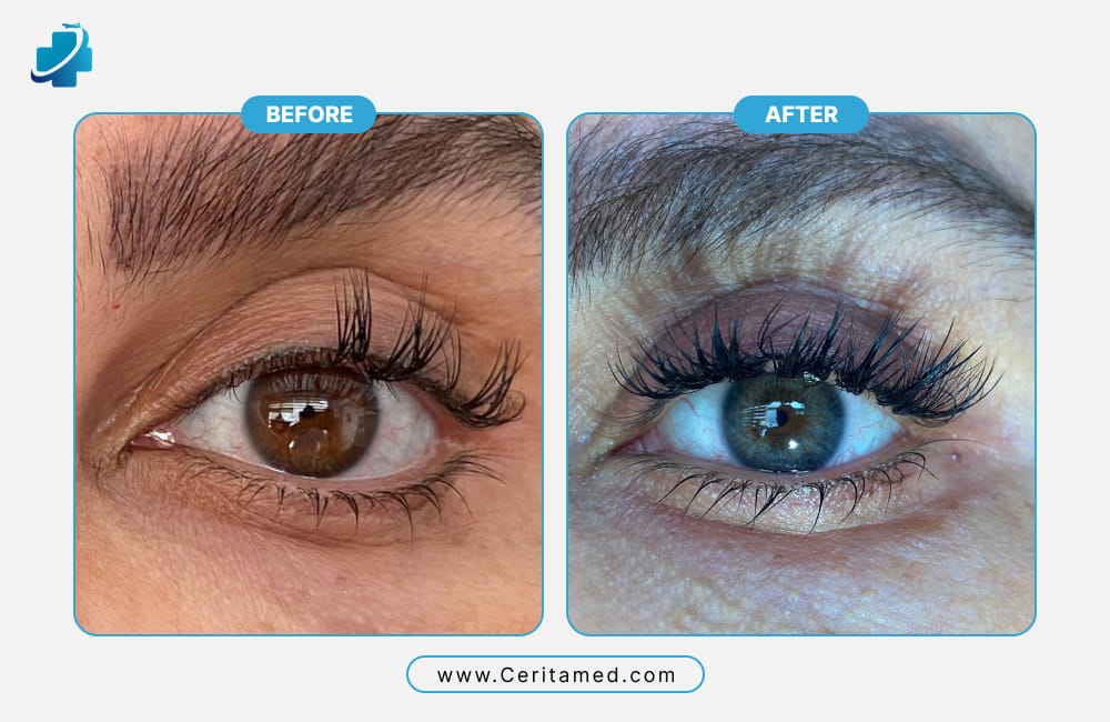 Before and after laser eye color change in Iran showing brown eyes transformed into blue-grey eyes.