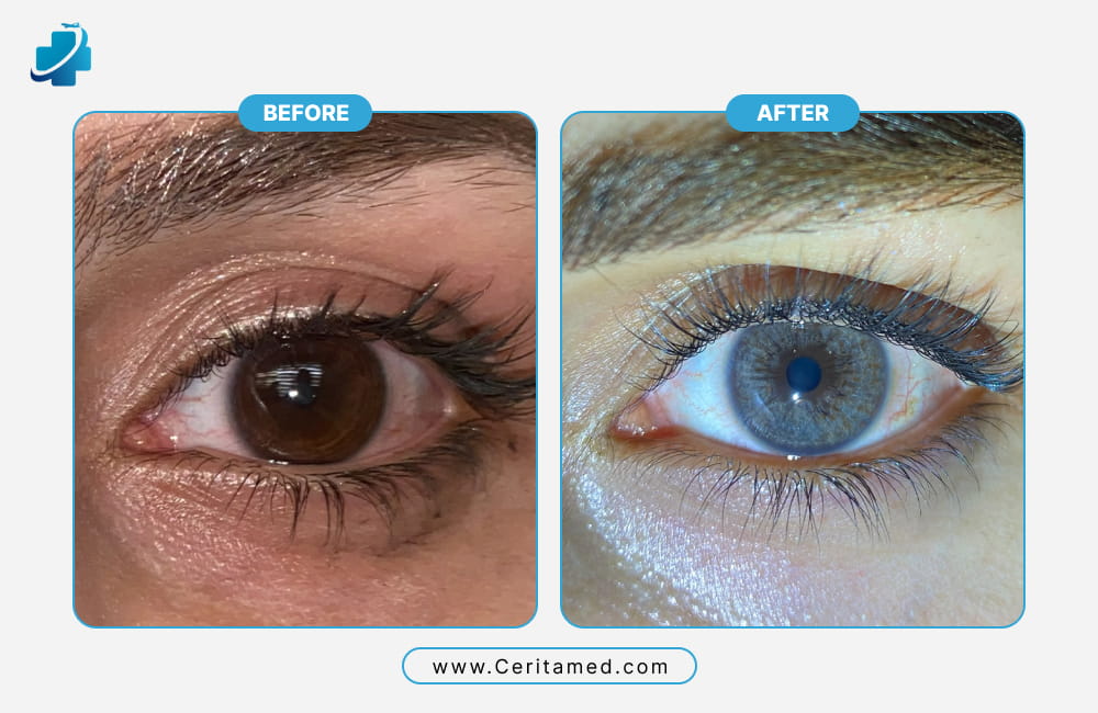 Before and after laser eye color change result showing transformation from brown eyes to ice-blue eyes.