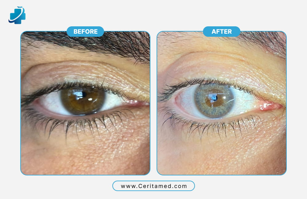 Before and after laser eye color change in Iran showing a light grey eye color transformation.