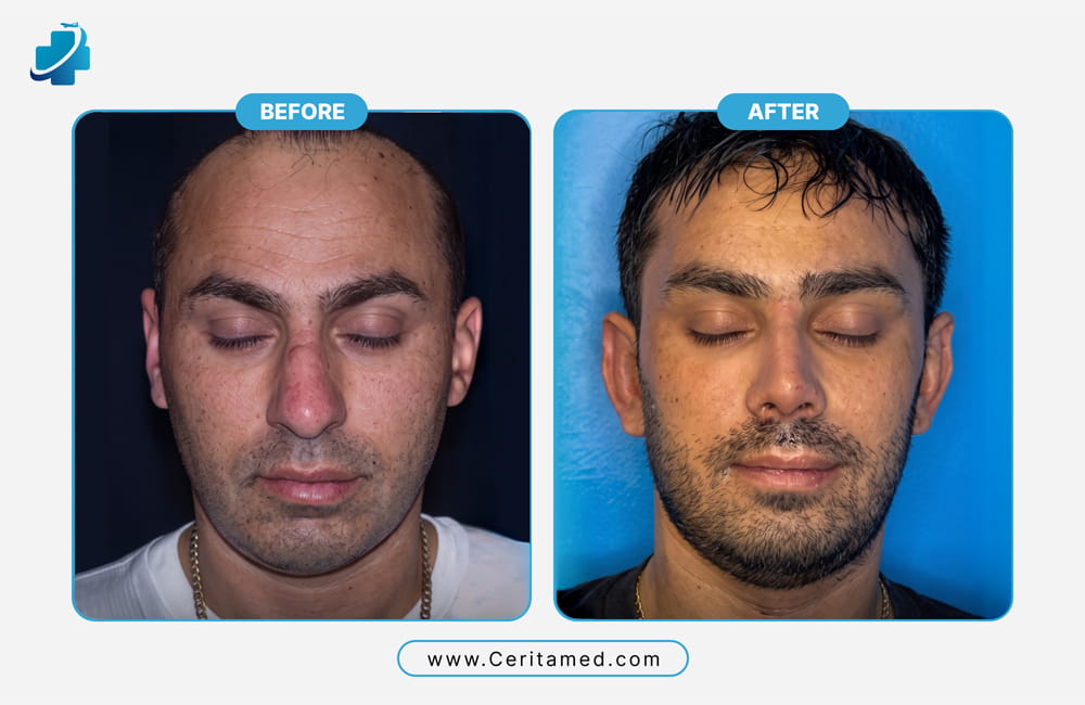 Facelift surgery in Iran before and after results from a real patient