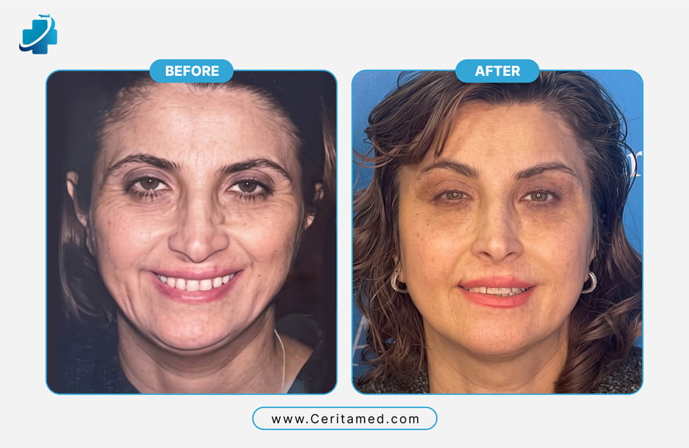Female facelift surgery in Iran before and after results