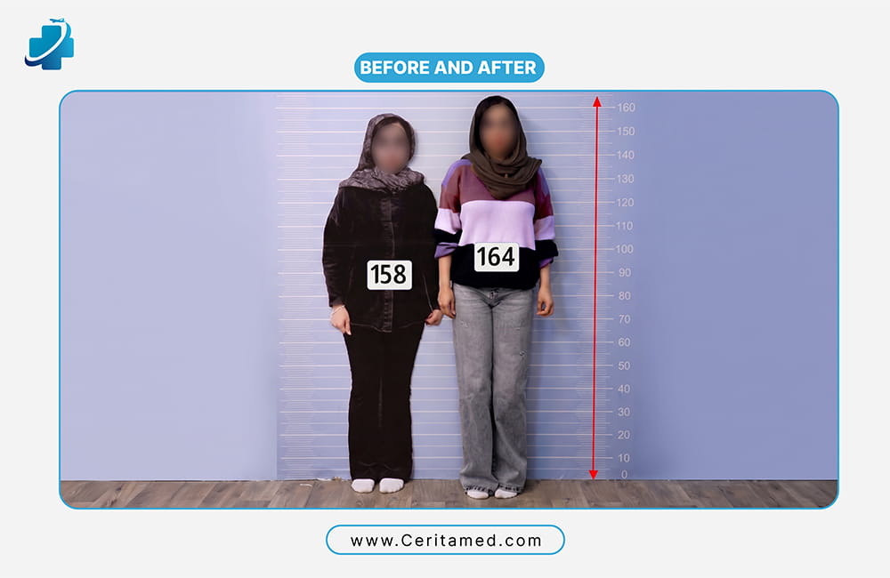 Female limb lengthening before and after: patient height increased from 158 cm to 164 cm