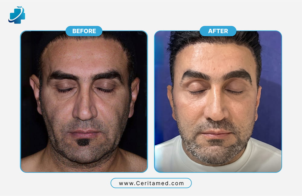 Real facelift before and after results in Iran