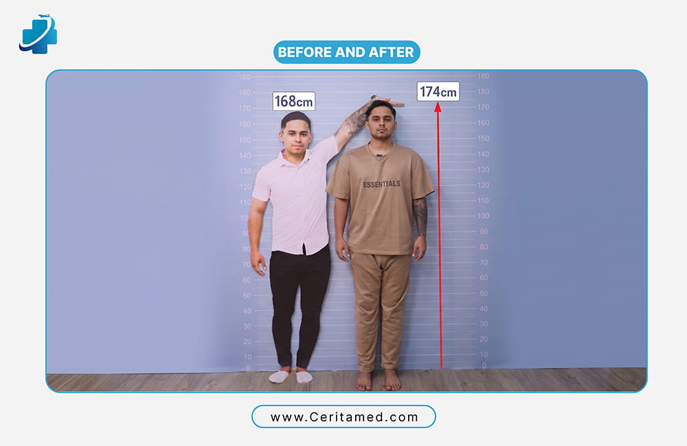 Leg lengthening before and after in Iran: patient height increased from 168 cm to 174 cm