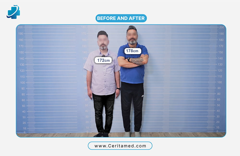 Limb lengthening before and after in Iran: patient height increased from 172 cm to 178 cm