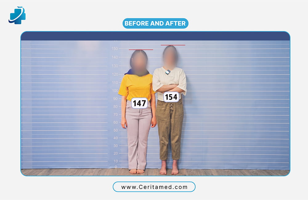 Limb lengthening result before and after: patient height increased from 147 cm to 154 cm