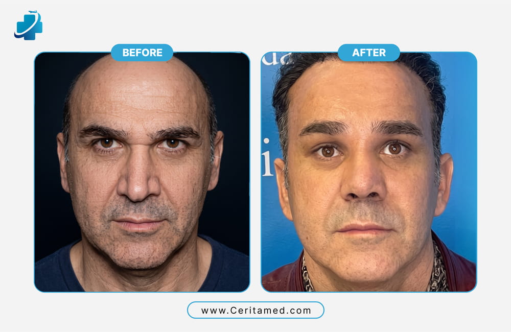 Male facelift in Iran before and after showing facial rejuvenation results